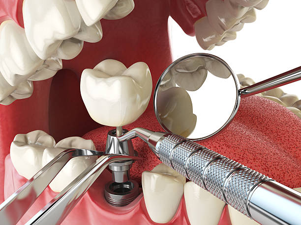 Best Emergency Tooth Extraction in Audubon, NJ